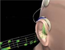 (Image - Cochlear Implant)
